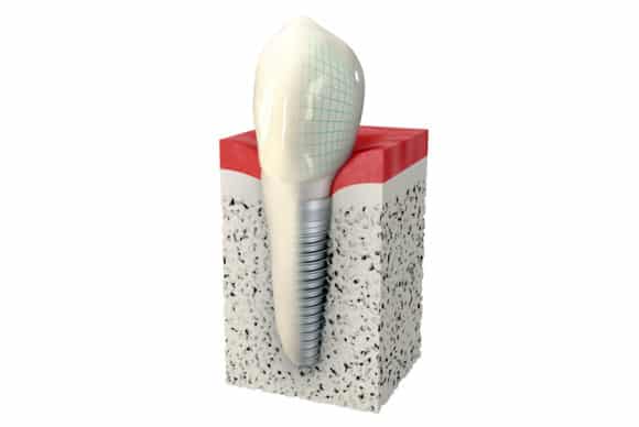 impianti dentali zagabria