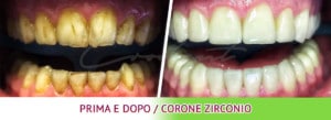 Prima e dopo dentale corone Croazia dentisti