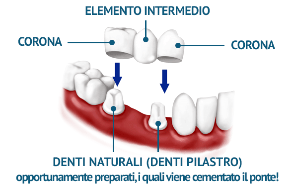 Ponte dentali fisso Croazia Corona Dentali